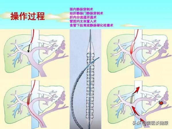 乙肝肝硬化階段,透過積極抗病毒和保肝治療後,效果欠佳怎麼辦? 乙肝肝硬化階段,透過積極抗病毒和保肝治療後,效果欠佳怎麼辦?