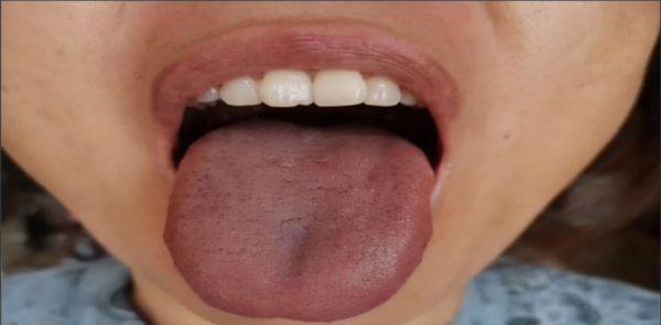 兩個位置測血瘀,一箇中成藥化淤血,4種血瘀體質瞭解一下 兩個位置測血瘀,一箇中成藥化淤血,4種血瘀體質瞭解一下