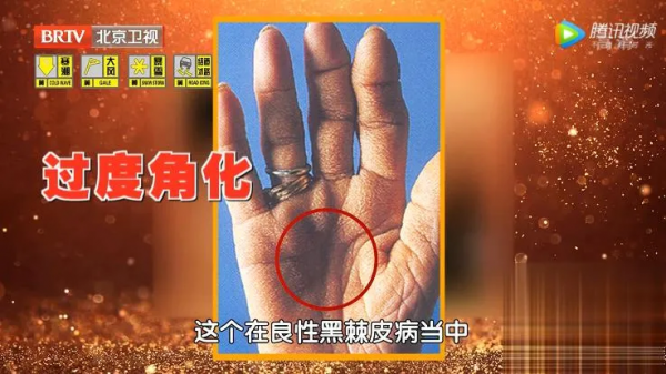 身上長出小疙瘩、紅斑，不痛不癢就沒事？警惕是惡性腫瘤潛伏體內