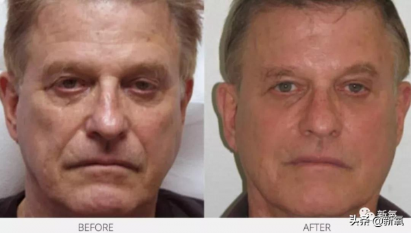 嘴角下垂對面容的影響有多大？