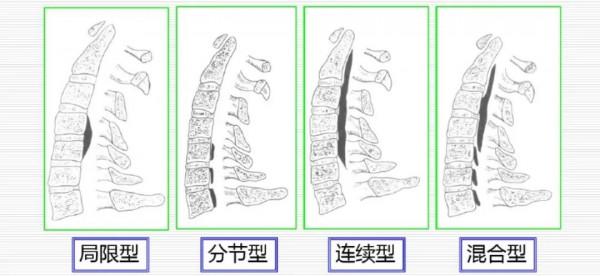 頸椎後縱韌帶骨化症