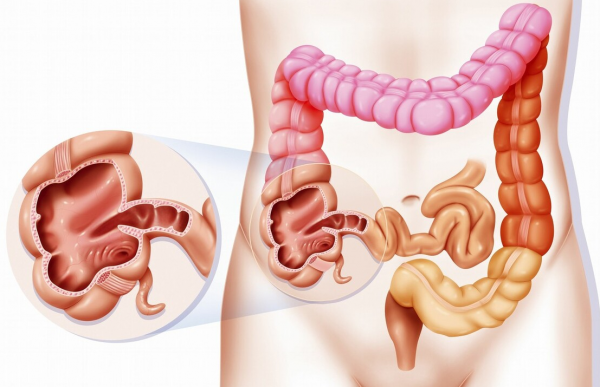 你知道我們有哪些&OpenCurlyDoubleQuote;腸&rdquo;嗎？一文給你說清楚結腸癌
