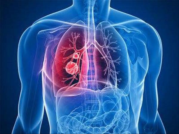 晚期肺癌病人，以前吸菸與不吸菸，治療方式差別很大