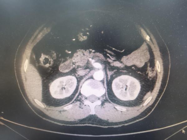 為什麼都是“上腹痛”，但是檢查不一樣？（三）