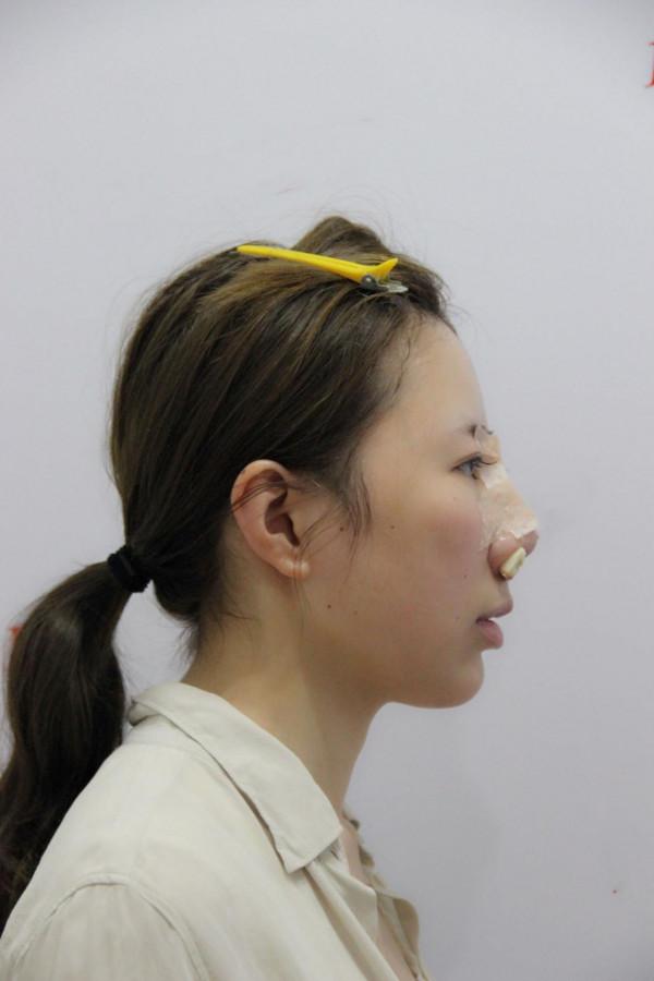 32歲寶媽自體脂肪填充50天，親戚以為我悄悄地換了一張臉