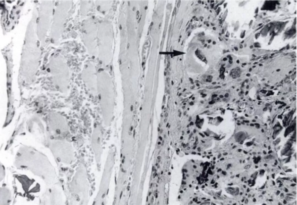 頸椎少見的3種鈣化性疾病 頸椎少見的3種鈣化性疾病