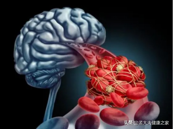 老年人預防腦梗與老年痴呆，如何補充葉酸與B12很重要，請看此文