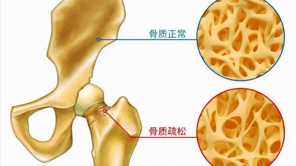 哪些人更容易患骨質疏鬆？&OpenCurlyDoubleQuote;1個公式&plus;1個測試&rdquo;教你自測骨質疏鬆