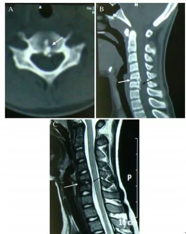 頸椎少見的3種鈣化性疾病 頸椎少見的3種鈣化性疾病