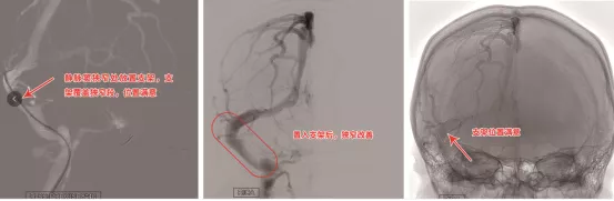 莫名頭痛伴視力模糊，竟是靜脈竇狹窄！支架置入“天塹變通途”