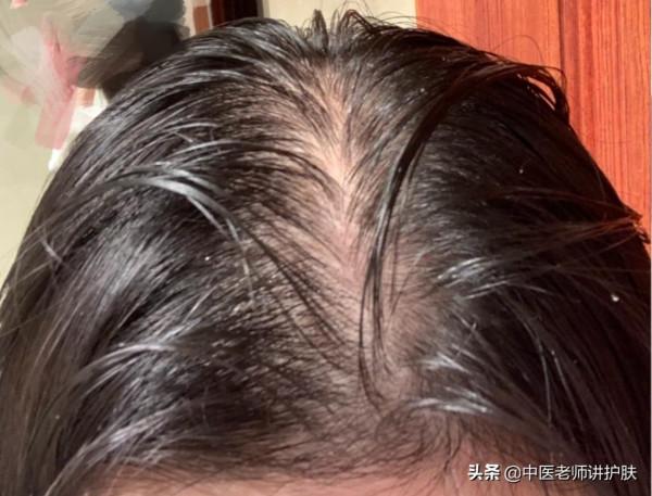 頭髮出油？是“痰溼”漂上來！送你兩個方子，一方化痰，一方生髮