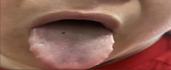 兩個位置測血瘀,一箇中成藥化淤血,4種血瘀體質瞭解一下 兩個位置測血瘀,一箇中成藥化淤血,4種血瘀體質瞭解一下