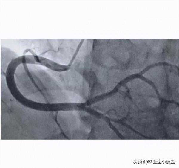 闢謠！冠心病好轉後就不用吃藥了嗎？有多少人因此放了心臟支架