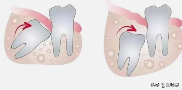 智齒為何總是成年出現?科學家給出結論,下巴空間有限 智齒為何總是成年出現?科學家給出結論,下巴空間有限
