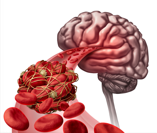 吲哚布芬，抗血小板兼抗凝，舒張血管、減輕炎症，防治心腦腎缺血