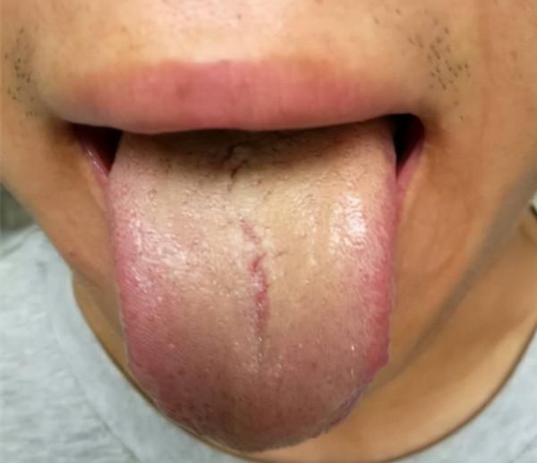 如何辨別寒溼和溼熱?看本文案例分析 如何辨別寒溼和溼熱?看本文案例分析