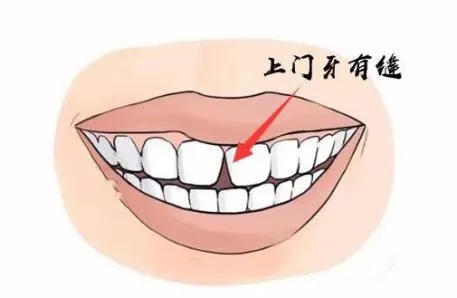 6-12歲換牙時間和換牙期問題大盤點！孩子一口好牙關鍵就在這幾點