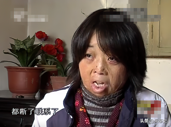 真實故事：山東女娃被開水燙成“鬼臉”，24歲結婚後又慘遭家暴