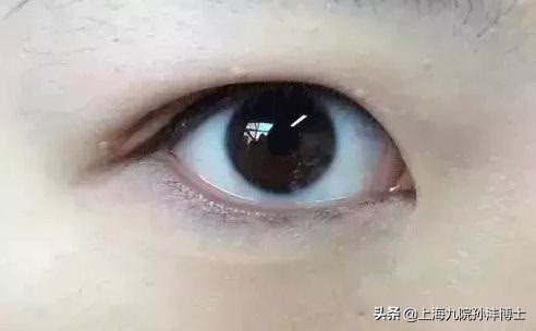 眼修復孫灃博士:上瞼下垂和腫眼泡哪一個問題更嚴重? 眼修復孫灃博士:上瞼下垂和腫眼泡哪一個問題更嚴重?