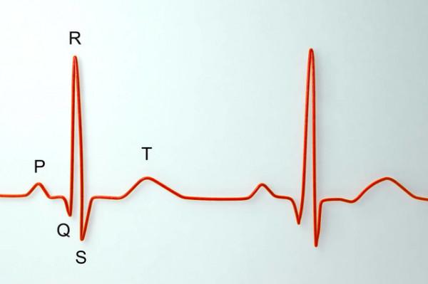 體檢心電圖提示“竇性心律”,是什麼病?心血管醫生告訴你 體檢心電圖提示“竇性心律”,是什麼病?心血管醫生告訴你