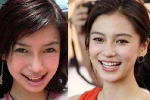 傅園慧整牙後&OpenCurlyDoubleQuote;洪荒少女&rdquo;變&OpenCurlyDoubleQuote;仙女&rdquo;，網友表示錯怪baby了