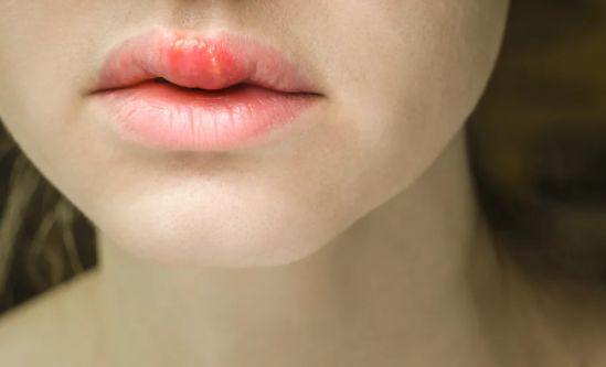 口傳皰疹又痛又癢還不敢戳，要想嘴唇不起皰，瞭解這3點就夠了