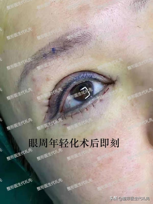 說一說我在北京做“眼周年輕化手術”的親身經歷和感受