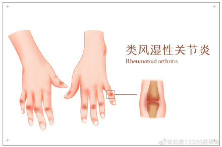 類風溼患者日常生活中應注意什麼？