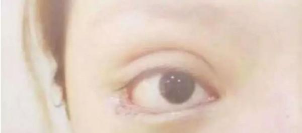 下三白眼科普：下瞼下至注意分寸！別過度醫療，錯把病態當美態