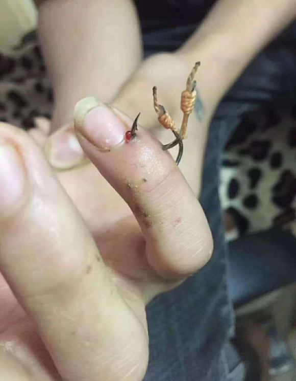 盤點釣魚人各種花式釣自己，看著就很疼！預防和處理方法分享