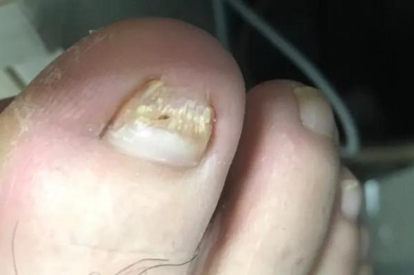 治療灰指甲的坑,你還想踩嗎? 治療灰指甲的坑,你還想踩嗎?