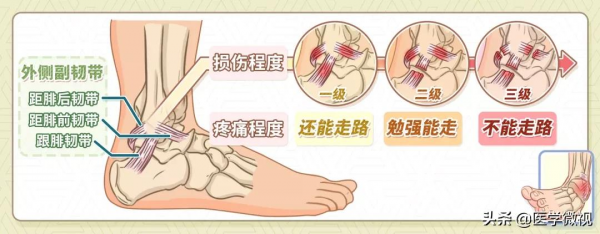 一次崴腳，次次崴腳，崴腳還容易“上癮”？