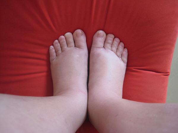 老人腳腫怎麼回事？常言道：“男怕穿靴，女怕戴帽”，是否如此