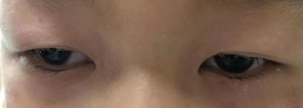 女童睫毛有魚腥味、黏糊糊,上手拔光睫毛的原因竟是毛囊裡藏蟲 女童睫毛有魚腥味、黏糊糊,上手拔光睫毛的原因竟是毛囊裡藏蟲