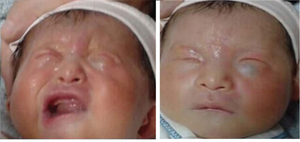 為什麼寶寶哭時,歪斜嘴巴總往一側歪斜 為什麼寶寶哭時,歪斜嘴巴總往一側歪斜