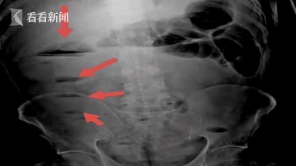 七旬老人便秘竟喝&OpenCurlyDoubleQuote;油&rdquo;通便，結果反致腸梗阻