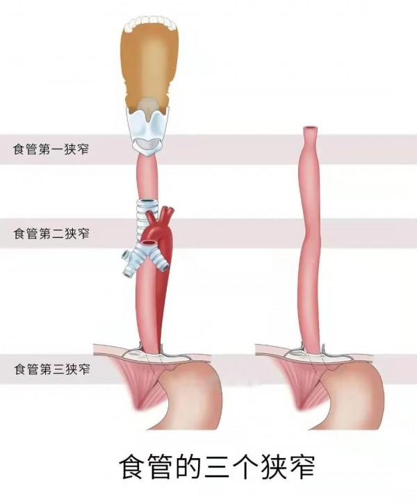 異物卡喉不少見，緊急處置需得當