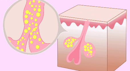 你不知道的關於痘痘的8個秘密