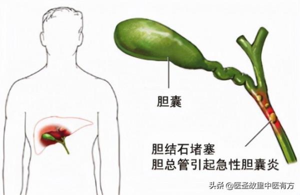 仲景名方大柴胡湯，清熱、消積、行氣、瀉下，善治便秘頭暈之症