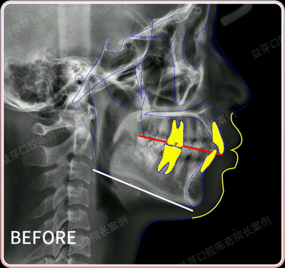 全球優秀案例 | 隱適美拔牙矯正1年半時間解除牙列間隙、改善嘴凸 全球優秀案例 | 隱適美拔牙矯正1年半時間解除牙列間隙、改善嘴凸