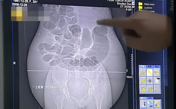 女子懷胎一年未生產遭到丈夫拋棄,身無分文的她挺著50斤巨肚流浪 女子懷胎一年未生產遭到丈夫拋棄,身無分文的她挺著50斤巨肚流浪