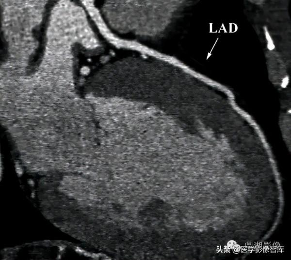 CT斷層解剖圖譜最全總結「推薦收藏」 CT斷層解剖圖譜最全總結「推薦收藏」