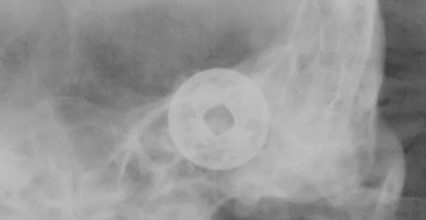 2008年，廣西出土傳說中的七星巨棺，棺內還有&quot;龍鬚&quot;纏繞