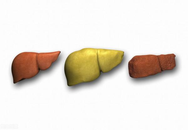 抗炎、降酶、抗纖維化,這種治療脂肪肝的中成藥,您一定要知道 抗炎、降酶、抗纖維化,這種治療脂肪肝的中成藥,您一定要知道