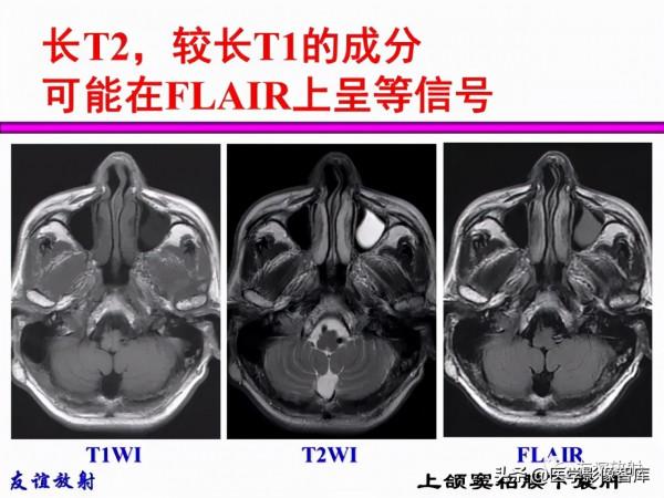 臨床MRI訊號分析基礎：常規序列及DWI序列