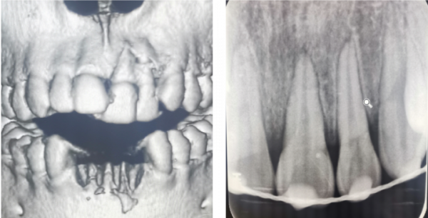 牙齒受了外傷，你知道該怎麼辦嗎？