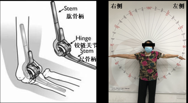 “不死的癌症”導致關節嚴重變形,一次手術後,她終於能抬手了 “不死的癌症”導致關節嚴重變形,一次手術後,她終於能抬手了