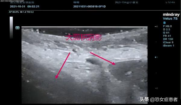 真實毒糧案例，淤血，發紺，無法站立，你不知道的毒糧症狀