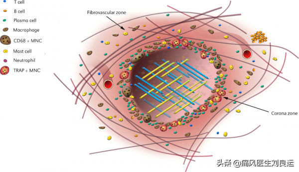 飲食清淡卻患上痛風這種“富貴病”，26歲小夥用針挑破痛風石