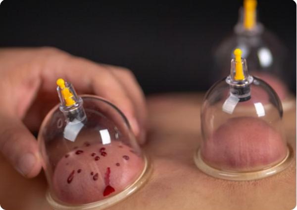 拔火罐時，後背吸出的瘀血，是排出的毒素嗎？聽聽醫生怎麼說